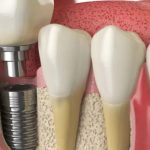 How A Reputable Dental Implant Clinic Handles Complex Cases