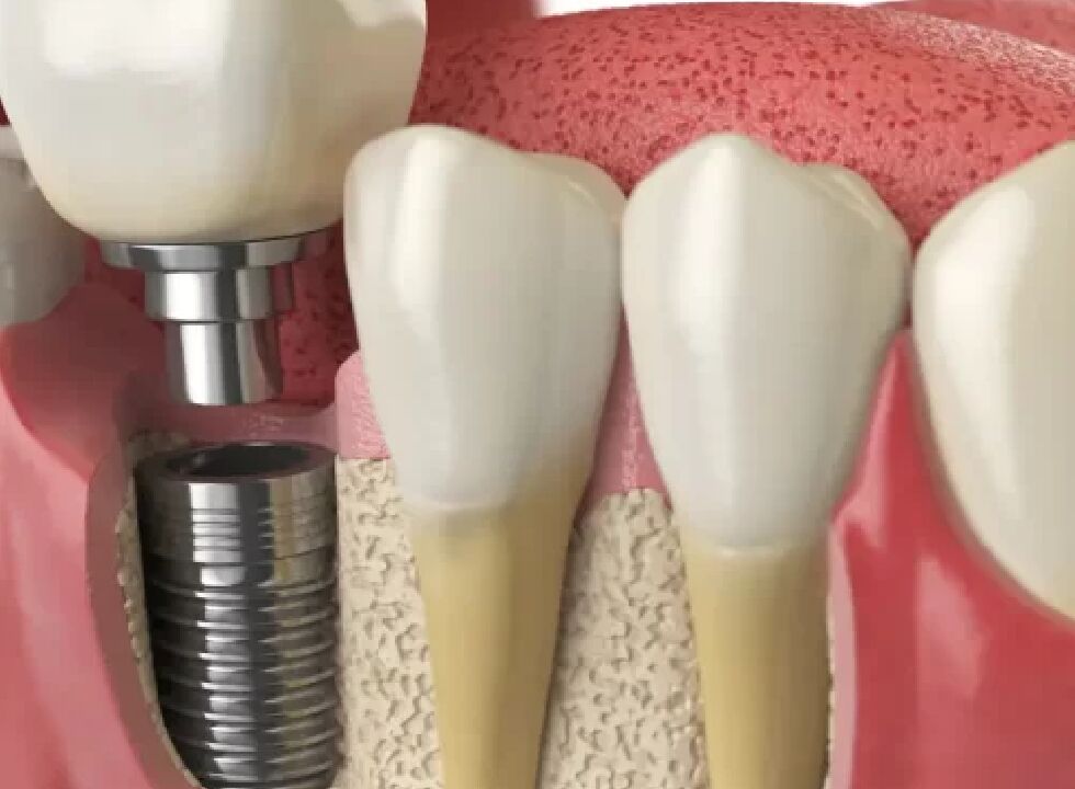 How A Reputable Dental Implant Clinic Handles Complex Cases